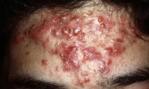 acne conglobata