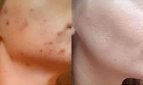 IMG_20170802_093810_606 acnepeeling