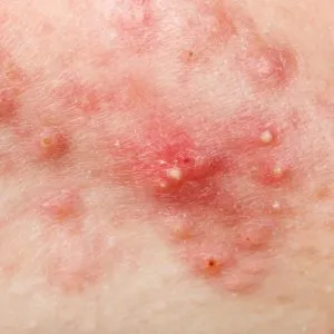 acne bij zwangerschap