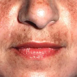 melasma-zwangerschap